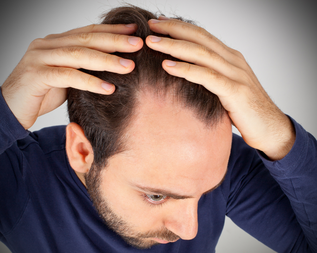 What Causes Hair Loss in Men: 6 Common Causes & What You Can Do About It |  Salt Grooming